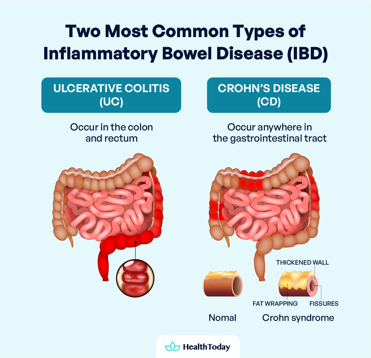 How To Calm Inflamed Intestines Causes and Treatment 01