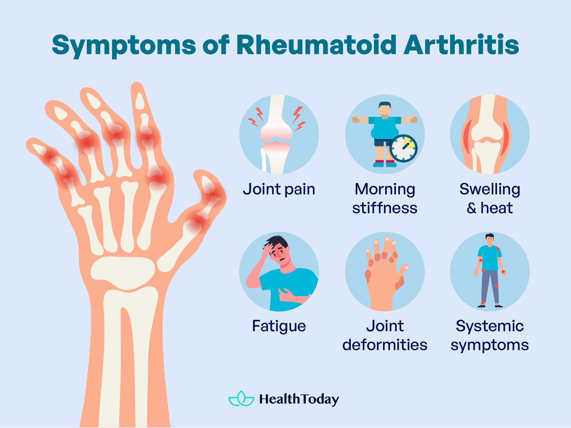 Symptoms and Long Term Effects of Rheumatoid Arthritis 01