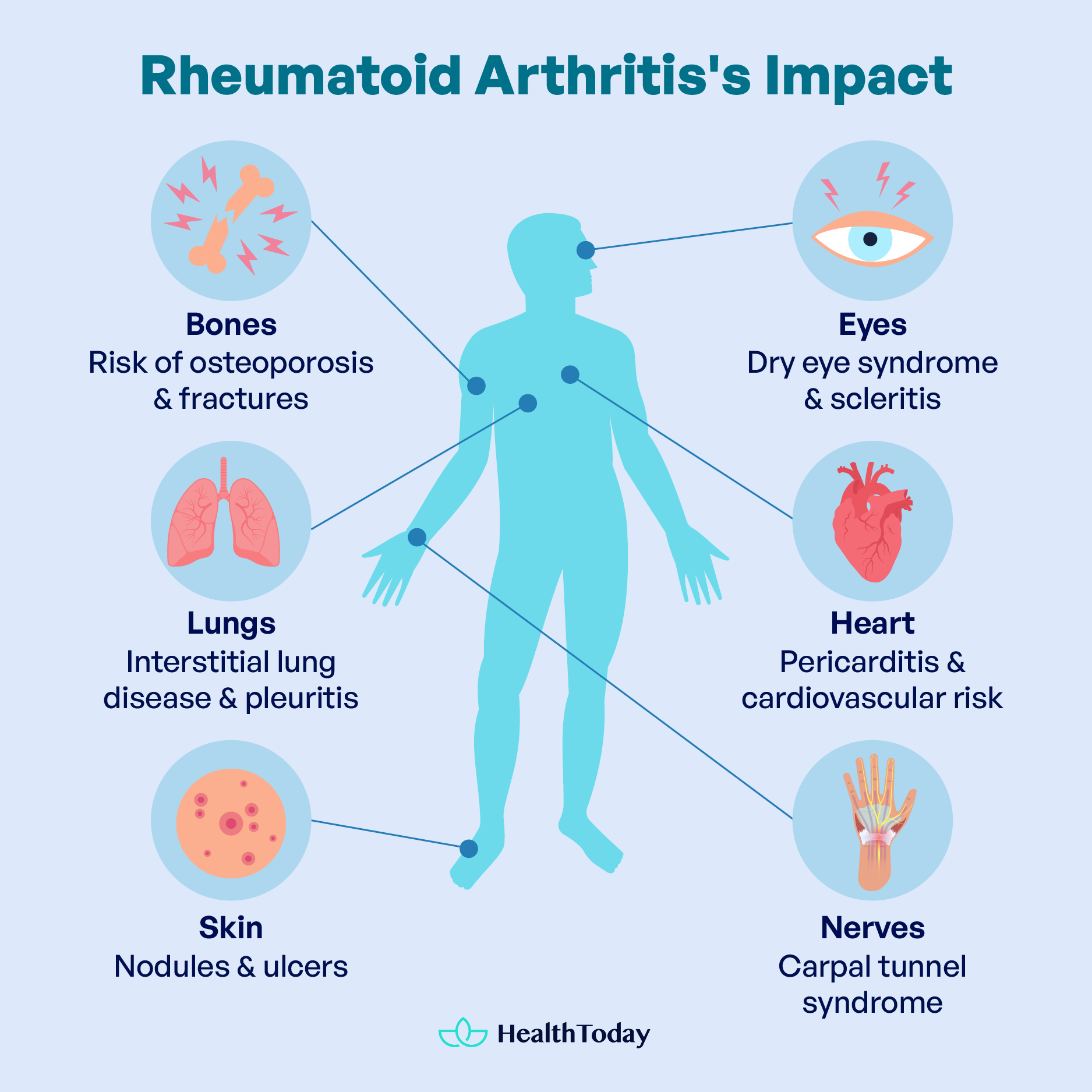 Symptoms and Long Term Effects of Rheumatoid Arthritis 02