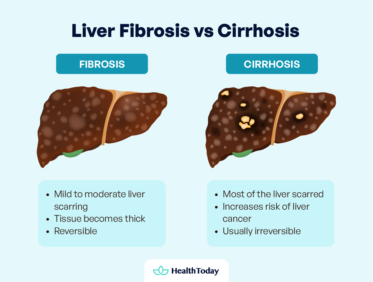 What Is Liver Fibrosis Causes Symptoms Stages and More 02